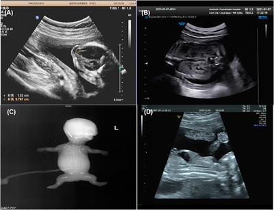 Molecular Diagnosis and Prenatal Phenotype Analysis of Eight Fetuses With Ciliopathies